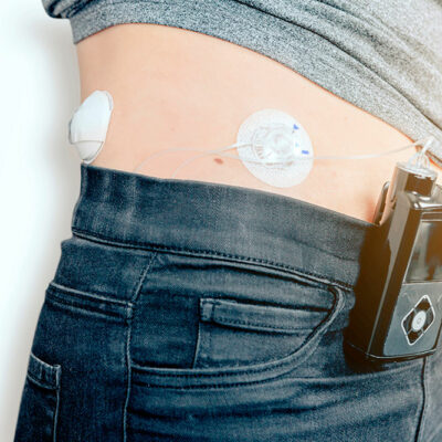 Insulin pumps – 3 best devices to buy in 2021