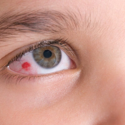 Eye infections – All you need to know