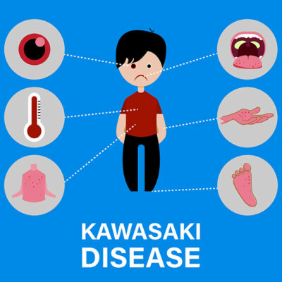 Kawasaki disease – causes and symptoms