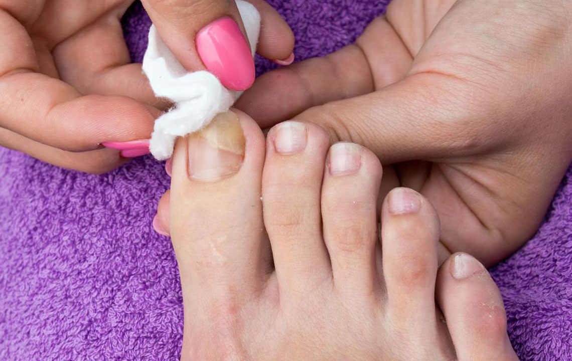 Nail Fungus – Causes, Symptoms, and Cure