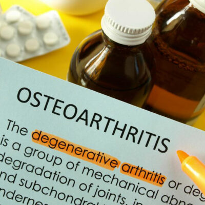Osteoarthritis – How to Treat it