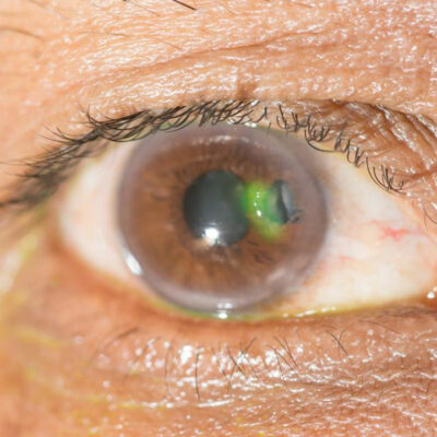 Various eye diseases and their symptoms